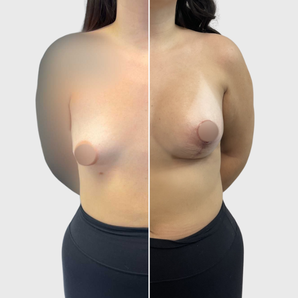 1.19.23 mok breast-preview