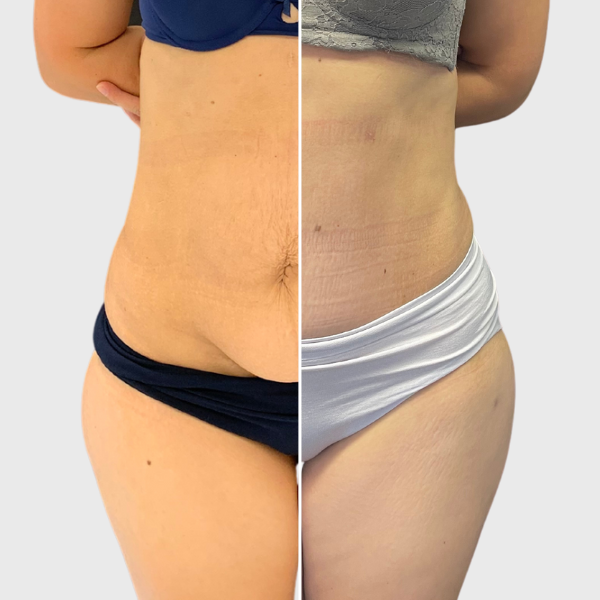 12.21.22 mok tummy fix-preview