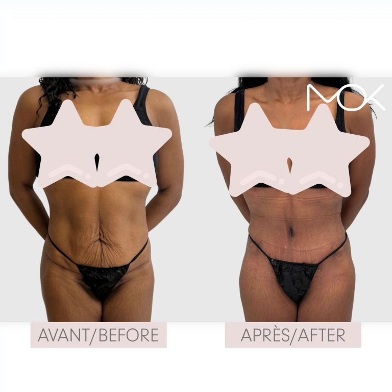 drmokplasticsurgery_376830062_855593539004184_8882587055143214943_n