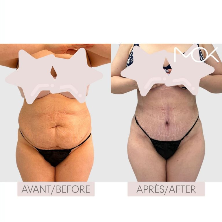 drmokplasticsurgery_377739213_1280774349308827_1428479572644254967_n