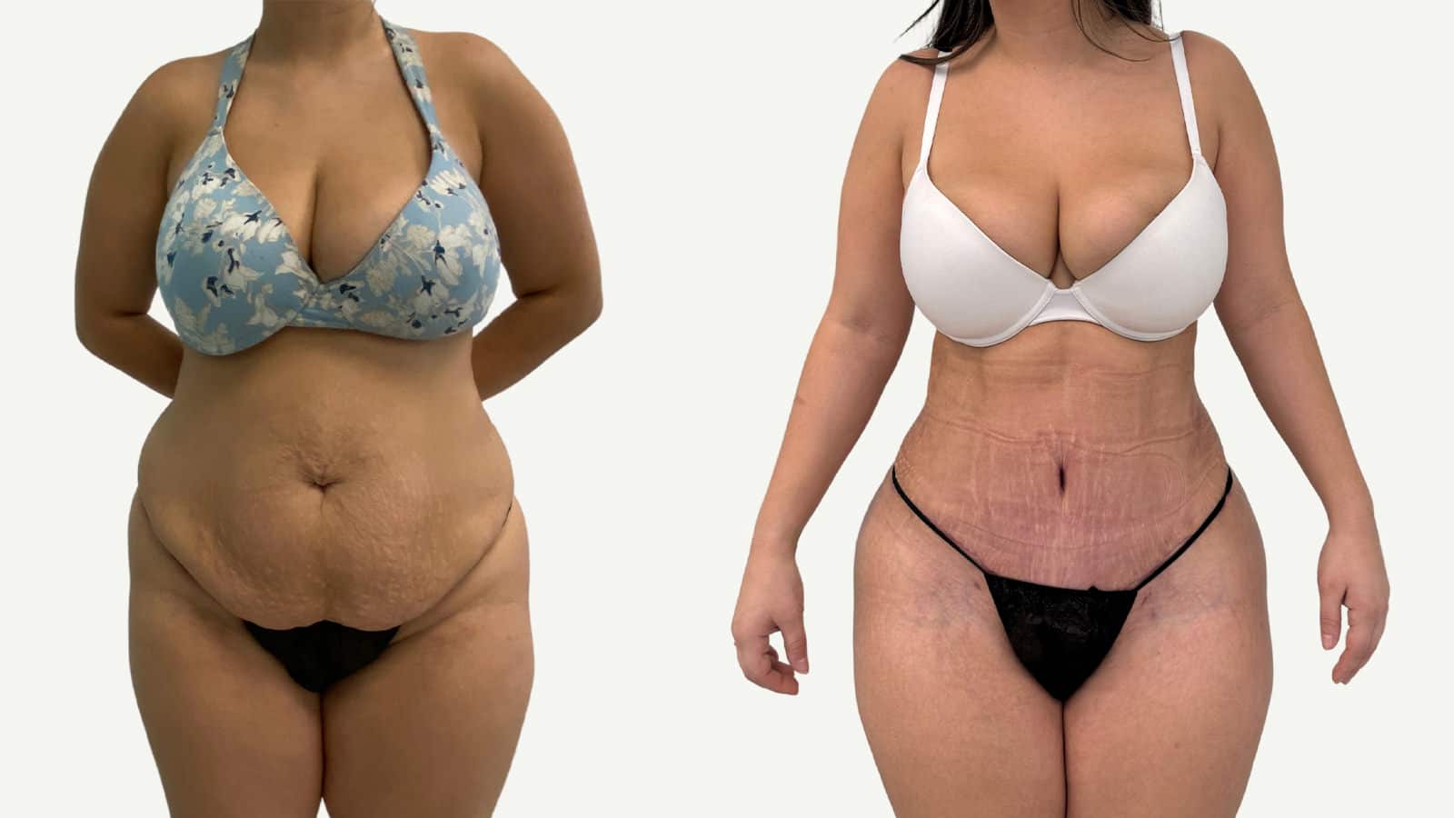 2 mois après abdominoplastie et liposuccion