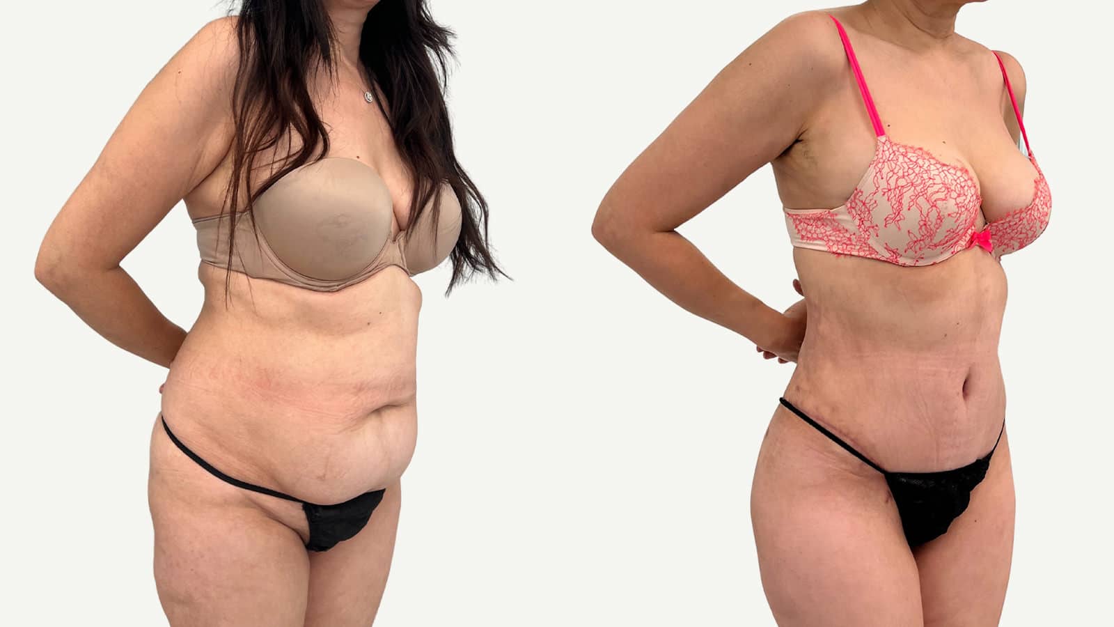2 mois après abdominoplastie et liposuccion
