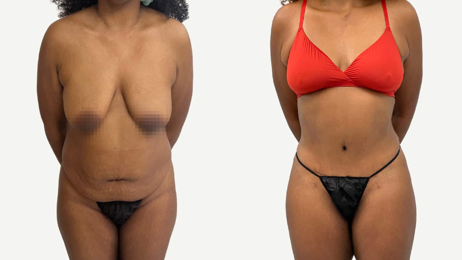 2 mois après abdominoplastie et liposuccion