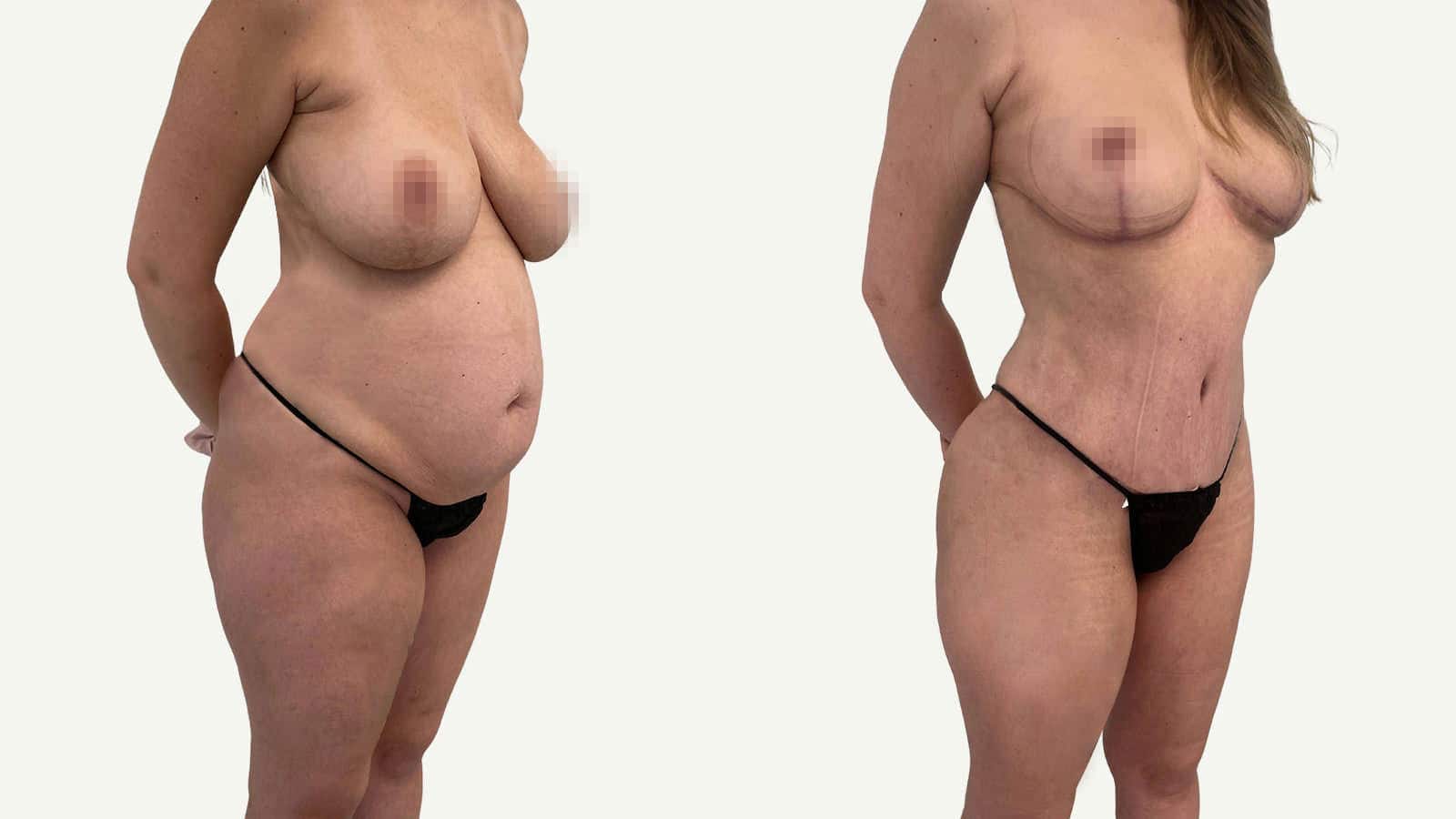 2 mois après abdominoplastie et liposuccion