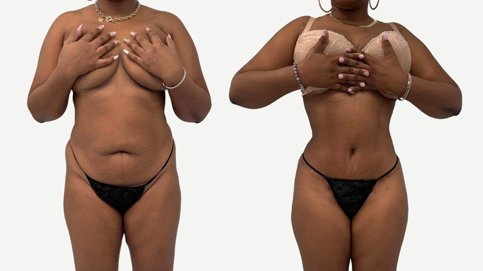 2 mois après abdominoplastie et liposuccion