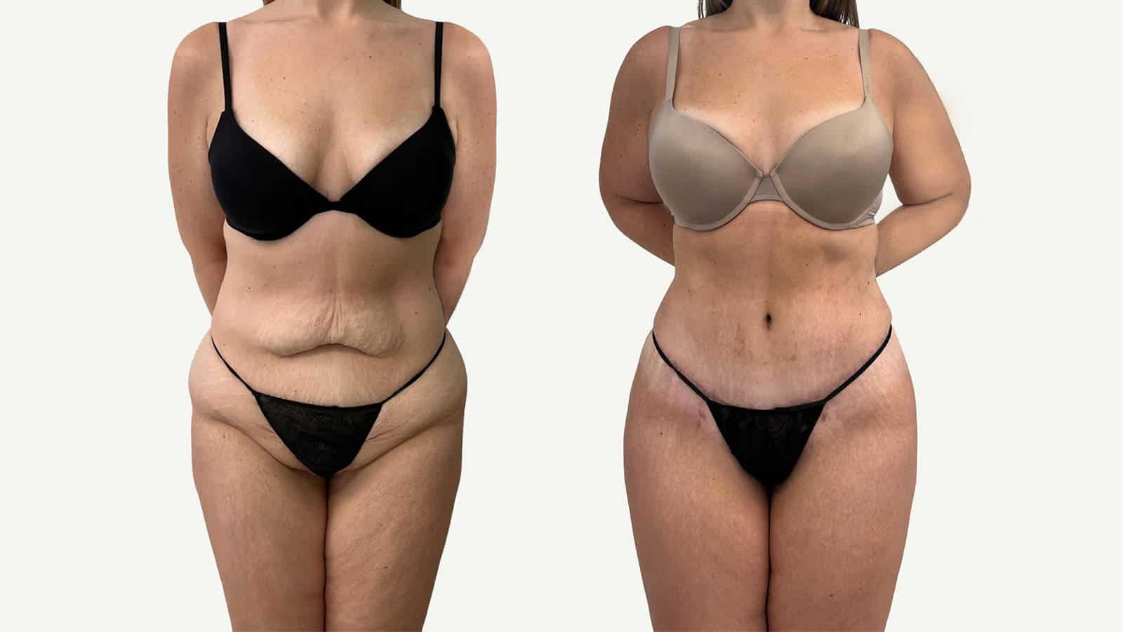 2 mois après abdominoplastie et liposuccion